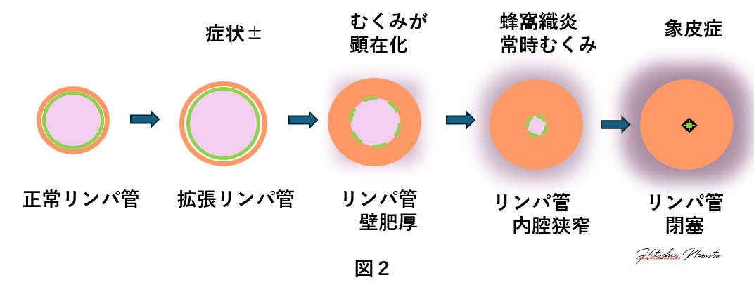 根本医師コラム,リンパ浮腫について