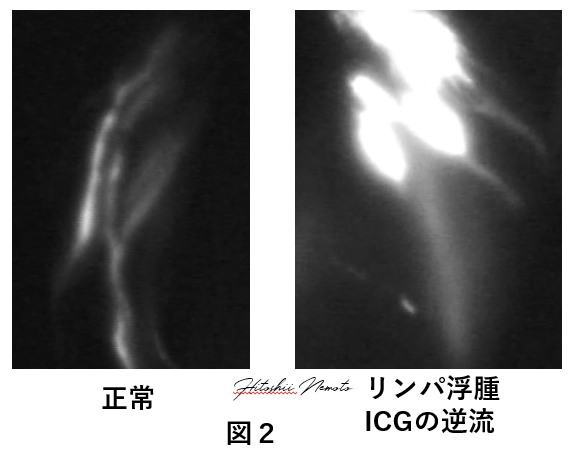 根本医師コラム,リンパ浮腫の検査について